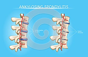 Spine Joints Arthritis Symptoms Vector Infographic