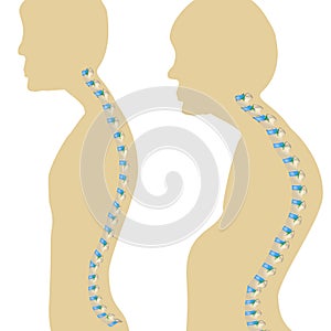 Spine kyphosis. Normal posture and kyphosis. Vector illustration on isolated background