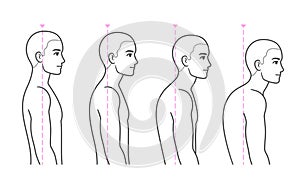 Spine kyphosis progression stages