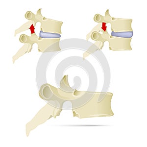 Spine, lumbar vertebra. Facet syndrome, advanced uncovertebral a photo