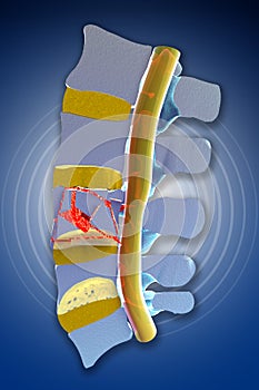 Spine, marrow, traumatic fractures vertebral