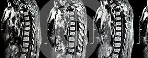 Spine metastasis ( cancer spread to thoracic spine )