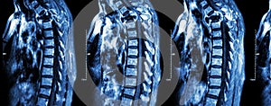 Spine metastasis ( cancer spread to thoracic spine ) photo