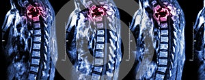 Spine metastasis ( cancer spread to thoracic spine )