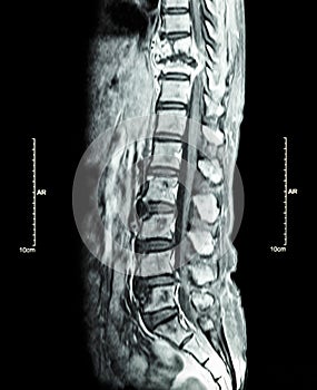 Spine metastasis ( cancer spread to thoracic spine ) photo