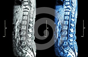 Spine metastasis ( cancer spread to thoracic spine photo