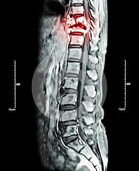 Spine metastasis ( cancer spread to thoracic spine ) ( MRI of thoracic and lumbar spine : show thoracic spine metastasis and compr photo