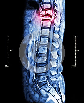 Spine metastasis ( cancer spread to thoracic spine ) ( MRI of thoracic and lumbar spine : show thoracic spine metastasis and compr photo