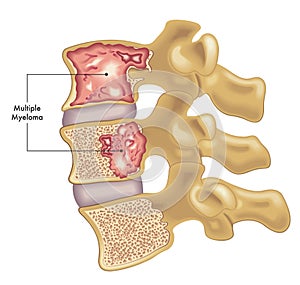 Spine with multiple myeloma