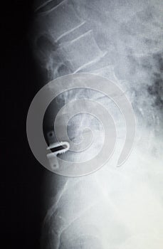Spine orthopedics spinal implant xray