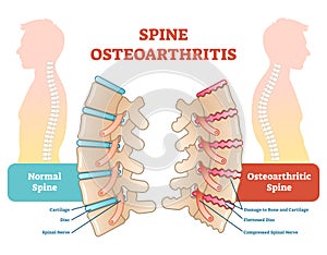 Spine osteoarthritis anatomical vector illustration diagram photo