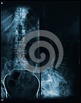 Spine and pelvis of a human body x-ray - front and lateral view