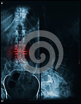 Spine and pelvis of a human body x-ray - red painful area