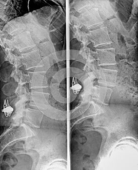 Spine and pelvis of a human body on x-ray. Two different split views