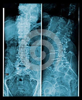 Spine and pelvis of a human body x-ray.