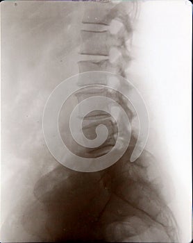 Spine and pelvis xray (x-ray)