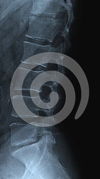 Spine radiograph photo