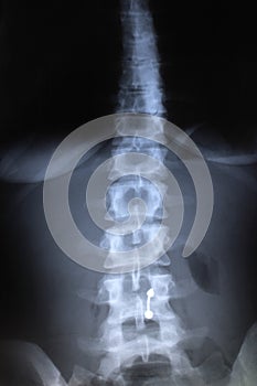 Spine Radiography - X Rays photo