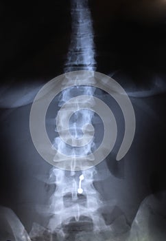 Spine Radiography - X Rays photo