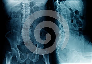 Spine x-ray