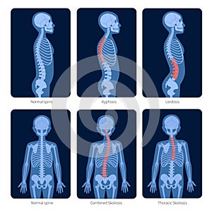 Spine X ray