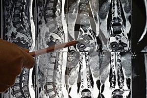 Spine x-ray film