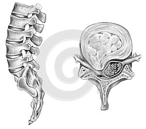 Spine - Ruptured Intervertebral Disc