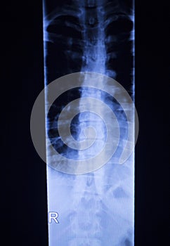 Spine vertebra back injury xray scan