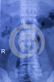 Spine vertebra back injury xray scan