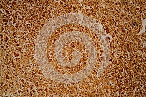 Spirocheteen of the syphillis liver tissue 200x photo