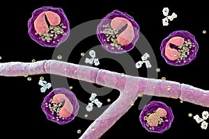 Splendore-Hoeppli phenomenon, 3D illustration. Eosinophilic reaction around the invading fungal hyphae in human tissues