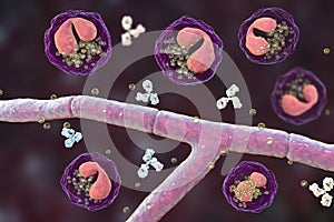 Splendore-Hoeppli phenomenon, 3D illustration. Eosinophilic reaction around the invading fungal hyphae in human tissues photo