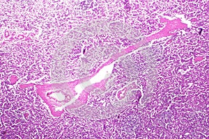 Splenic arterioles hyalinization