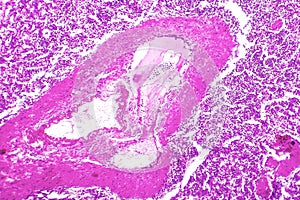 Splenic arterioles hyalinization