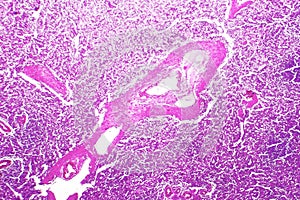 Splenic arterioles hyalinization photo