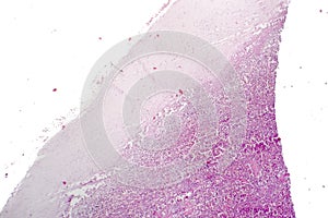 Splenic capsule hyaline degeneration