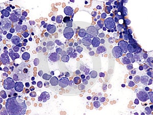 Splenic diffuse large B-cell lymphoma.