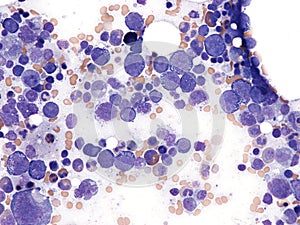 Splenic diffuse large B-cell lymphoma. photo