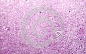 Splenic infarction, photo under microscope photo