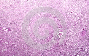 Splenic infarction, photo under microscope