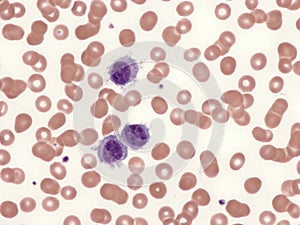 Splenic lymphoma with circulating villous lymphocytes. photo