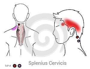 Managing upper shoulder and side headaches pain caused by myofascial trigger points in the Splenius Cervicis muscle photo