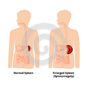 Splenomegaly of the spleen. Enlargement of the spleen. Vector illustration on isolated background