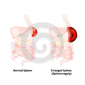 Splenomegaly of the spleen. Enlargement of the spleen. Vector illustration on isolated background