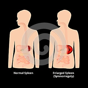 Splenomegaly of the spleen. Enlargement of the spleen. Vector illustration on isolated background