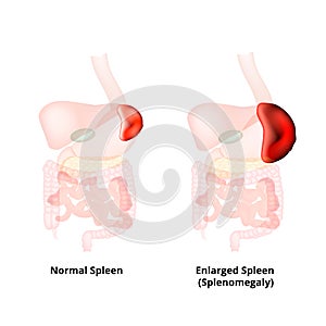 Splenomegaly of the spleen. Enlargement of the spleen. Vector illustration on isolated background photo