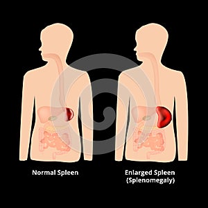 Splenomegaly of the spleen. Enlargement of the spleen. Vector illustration on isolated background photo