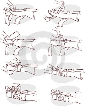 Splinting a Broken leg