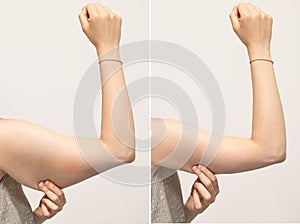 A split screen of a woman pinching the skin beneath her arm.