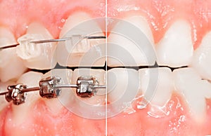 Split view of braces and tooth before them photo
